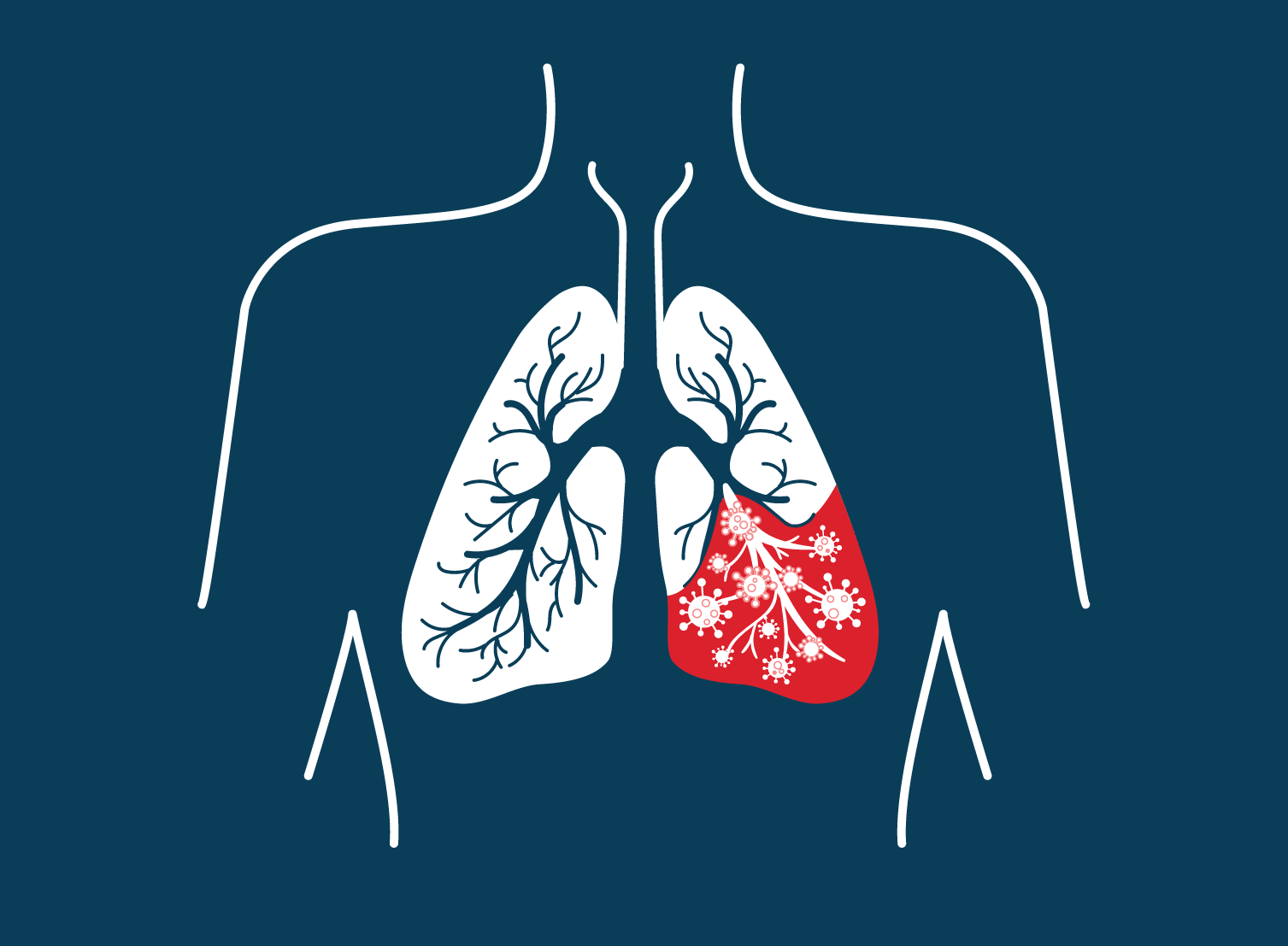 Sintomas de pneumonia: quais são, diagnóstico e tratamento